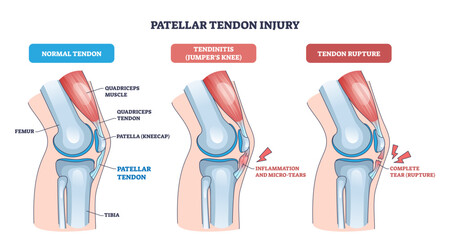 Patellar tendon injury visualizes normal, tendinitis, and rupture, focusing on patella, patellar tendon, and quadriceps to convey knee pain progression, transparent background.