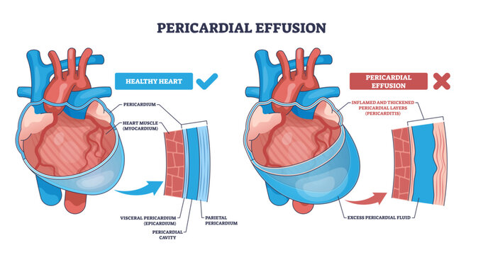 Pericardial effusion outline illustrates fluid buildup compressing the heart, contrasting normal and inflamed pericardium, key objects, heart, pericardial layers, excess fluid, transparent background.