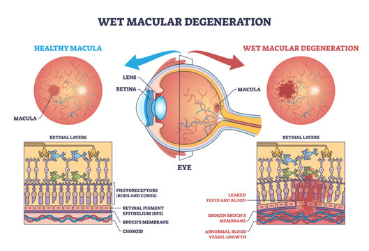 Wet macular degeneration shown in a brief eye cross-section comparing healthy and diseased macula, retina and abnormal blood vessels depict leakage causing central vision loss, transparent background.