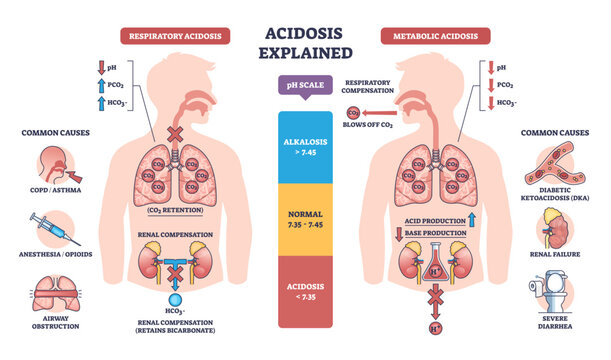 Acidosis explained contrasts respiratory and metabolic imbalance, lungs, kidneys, and pH scale highlight CO2 retention and acid buildup for quick understanding, transparent background.