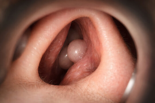 Photorealistic ENT endoscopic view of nasal cavity with a small nasal polyp plus allergic-type mucosal edema: pale polyp with smooth surface, mildly swollen pink mucosa, thin clear mucus film