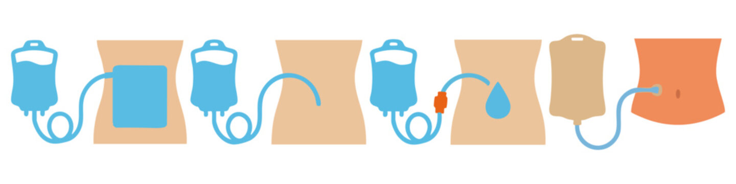 PERITONEAL DIALYSIS - Soft pouch with a tube and abdominal outline  Flat Vector Illustration on Transparent Background