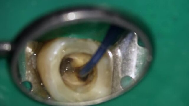 Educational molar canal procedure. Demonstration of file placement in molar canal under isolation. Sequential imagery of tool engagement during molar canal filing process for training purposes