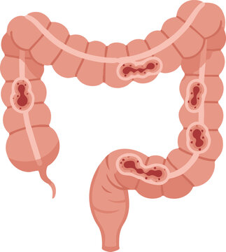 Medical illustration of the large intestine showing multiple inflamed diverticula pouches along the colon wall, representing diverticulitis, abdominal pain, and digestive tract disease.