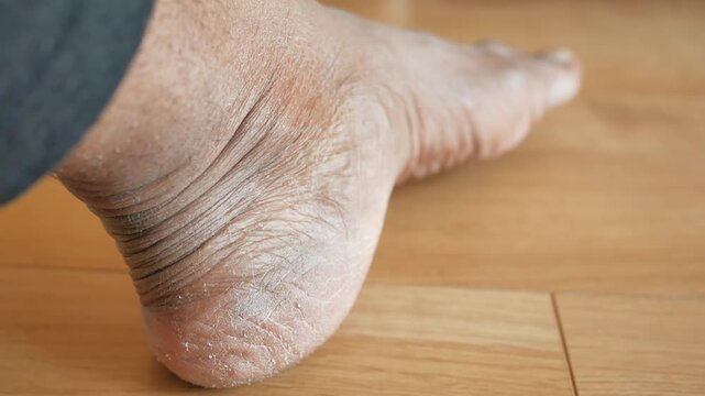 A close up view of an adult male's left heel displaying dry and cracked skin, suggesting a need for foot care, footage