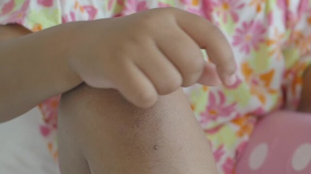 Little child scratching itchy skin on knee with dry patches and rash at home