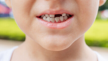 Close-up of a smiling kid showing a gap after losing a milk tooth.