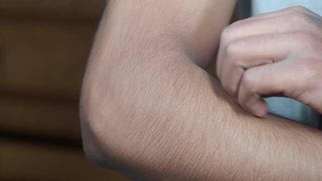 Young man scratching itchy hand skin with red spots in close up view providing relief from allergic reaction or insect bite