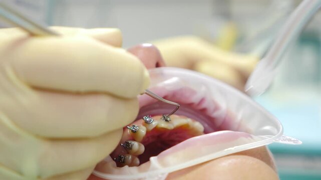 Orthodontist using pliers to handle thin archwire during dental braces adjustment. Gloved hands demonstrate precise control and careful fixation of orthodontic wire in clinical setting. 4 k video
