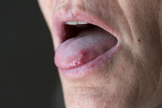 Painful canker sore on tongue macro oral health problem