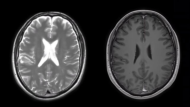 Digital Anatomy of the Brain in MRI Rotation. MRI scanning with spatial layer analysis in brain research demonstrates the technology's high effectiveness in detecting abnormalities