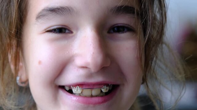 Portrait, open smile with healthy teeth, before after orthodontic correction plate, emotional comfort for child.