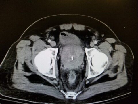 CT pelvis showing prostatic enlargement and femoral heads
