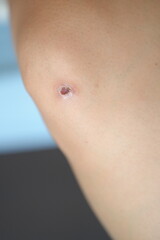 Fototapeta premium Small scab wound on a human knee showing a minor skin injury during the healing process