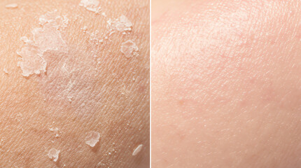 Fototapeta premium Close-up comparison of dry, flaky skin on the left and smooth, hydrated skin on the right, highlighting skin condition improvement or skincare effects