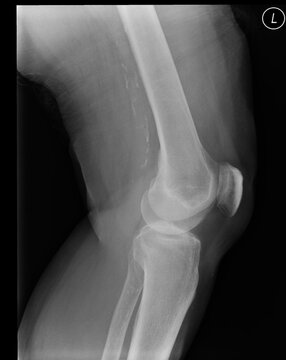 An X-ray of a human knee (seventy-three-year-old woman), lateral projection