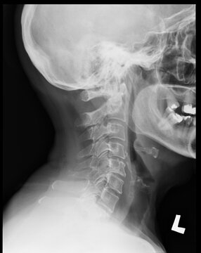A lateral cervical spine X-ray of a 67-year-old female