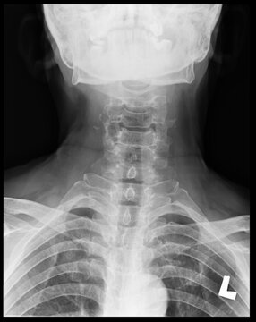 An AP view, cervical spine X-ray of a 67-year-old female
