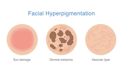Facial hyperpigmentation. vascular pigmentation, sun damage and dermal melasma on facial skin. Diagram about dark spots, uneven skin tone, melanin and pigmentation problems.