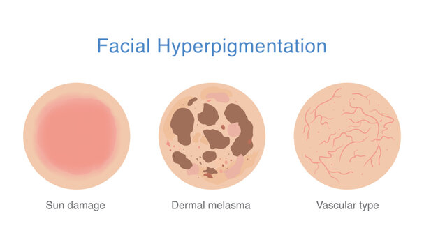 Facial hyperpigmentation. vascular pigmentation, sun damage and dermal melasma on facial skin. Diagram about dark spots, uneven skin tone, melanin and pigmentation problems.