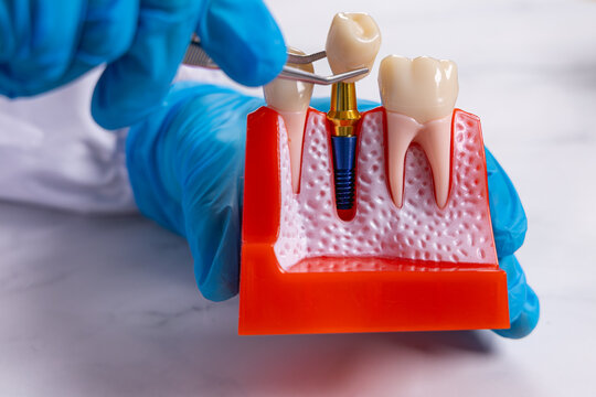 Un dentiste en train de mettre la couronne sur le sch&eacute;ma 3D d'implant dentaire.