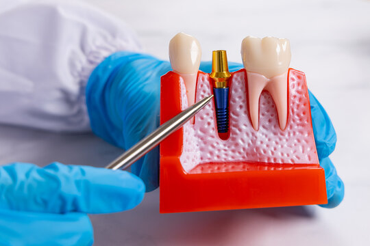 Gros plan sur un dentiste pointant avec son stylo la vis d'un sch&eacute;ma 3D d'implant dentaire.
