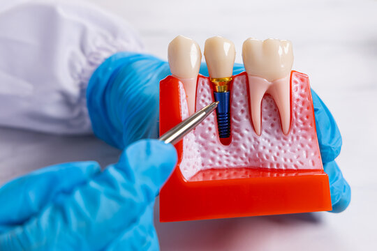 Gros plan sur un dentiste pointant avec son stylo un  sch&eacute;ma 3D d'implant dentaire.