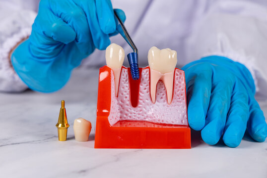 Un dentiste retirant le pilier vis d'un implant dentaire avec une pince. Ses mains ont des gants en nitrile bleu.