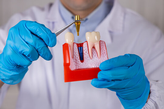 Un dentiste retirant un le pilier d'un implant dentaire avec une pince dentaire. Ses mains ont des gants en nitrile bleu. En arri&egrave;re plan, il est habill&eacute; avec une blouse blanche m&eacute;dicale.