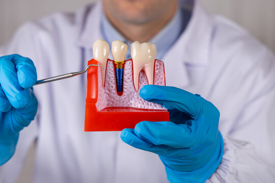 Un dentiste montrant un implant dentaire avec un pic dentaire. Ses mains ont des gants en nitrile bleu. En arri&egrave;re plan, il est habill&eacute; avec une blouse blanche m&eacute;dicale.