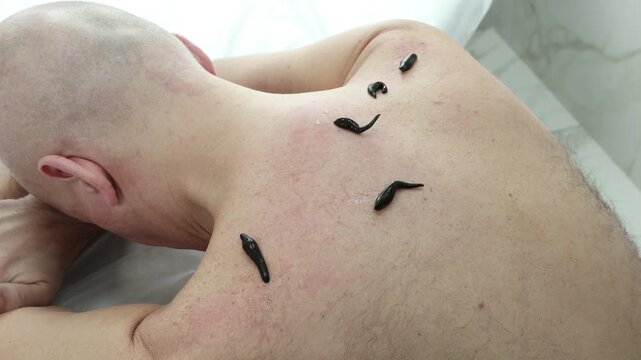 Hirudotherapy treatment with leeches at a medical clinic