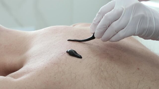 Hirudotherapy treatment with leeches at a medical clinic