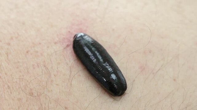 Hirudotherapy treatment with leeches at a medical clinic