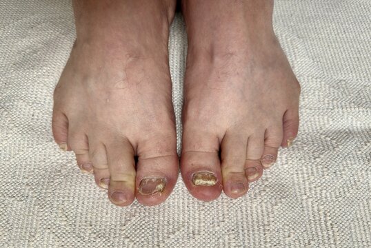 Onychomycosis. Process of hardware treatment of toenails by a doctor with various diamond feathers. Dangerous fungal infection of toenails in person sitting in an examination chair. Regular cleaning