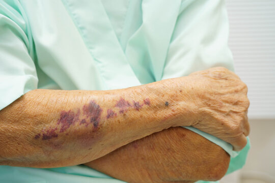 Ecchymosis, elderly bleeding on her arm after taking aspirin.
