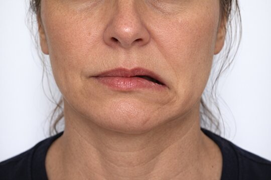 A close‑up of the lower face showing asymmetric mouth positioning with one corner pulled downward, highlighting facial droop and clinical evaluation of nerve‑related facial changes.
