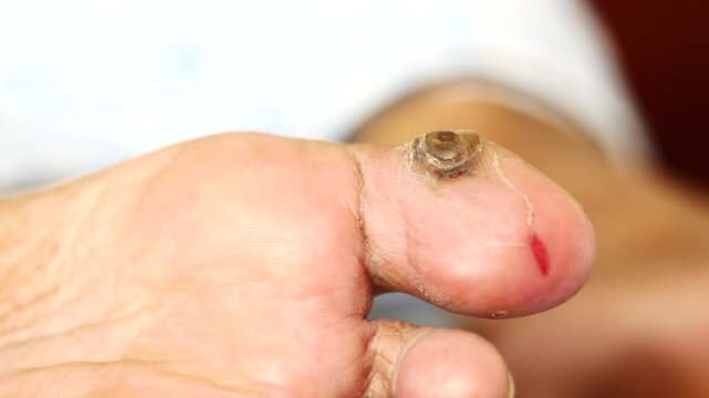 Close-up view of a painful wart and broken skin on toe with blood spot