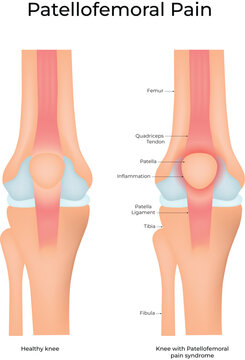 Patellofemoral Pain Syndrome Knee Anatomy Medical Vector Illustration