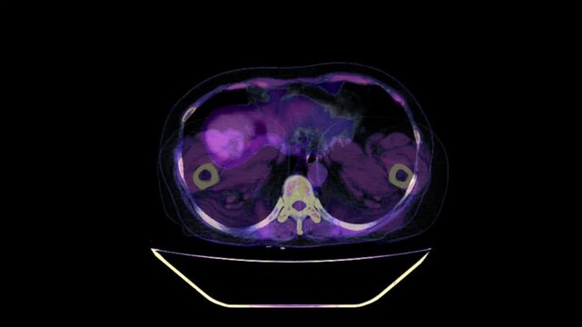 Nephrolithiasis, kidney stones abdomen ct scan
