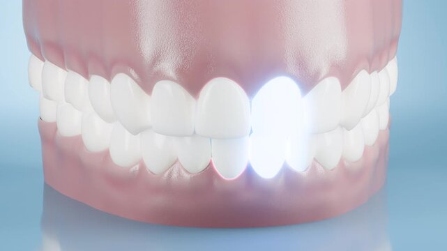 3D dental animation depicts plaque buildup along the gum line on human teeth against a blue background. Light beams blast away bacteria and clean stained teeth