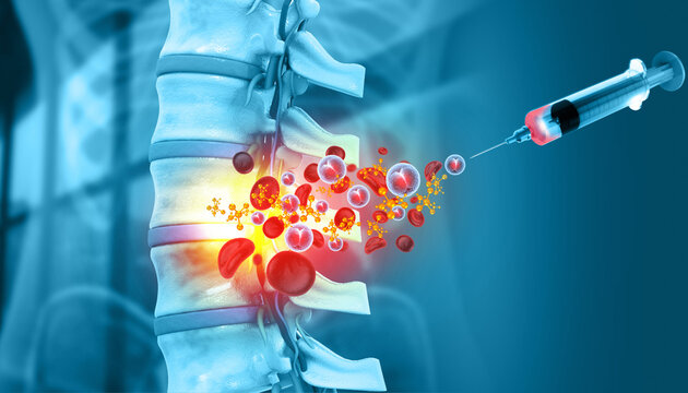 Injection into the human spine. Platelet Rich Plasma for spine Osteoarthritis. 3d illustration