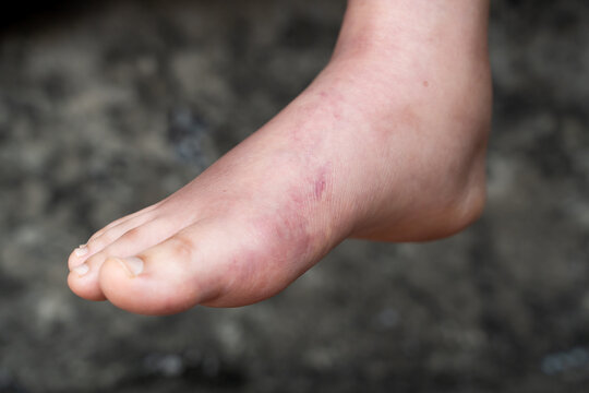 Swollen Foot After Cast Removal of Metatarsal Fracture