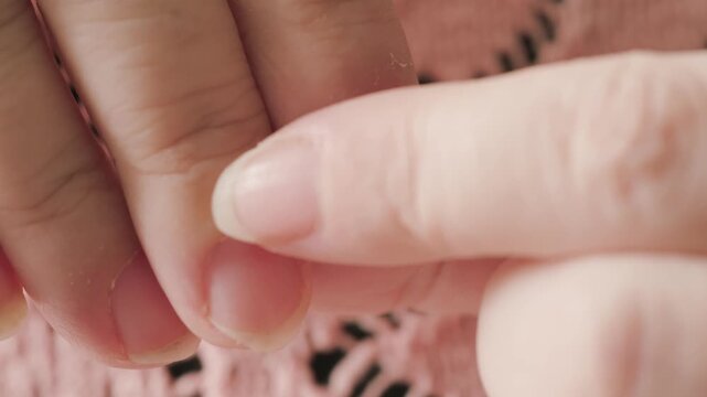 hangnails on fingers, skin scrap, area of ​​exfoliated epidermis surrounding nail, Compulsive nail and cuticle biting, Stress relief or self-harm, obsessive-compulsive disorder, mental health