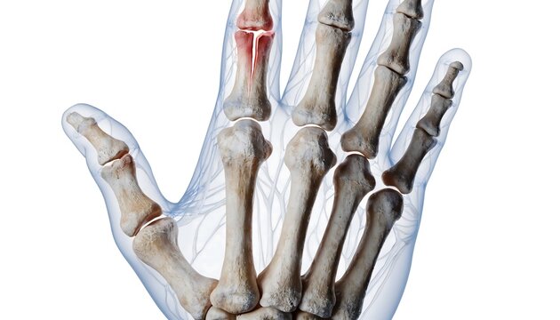Detailed 3D medical illustration of a human hand featuring a fracture in the phalanges and metacarpals. Translucent soft tissues and a red highlighted break on a white background for clinical use.