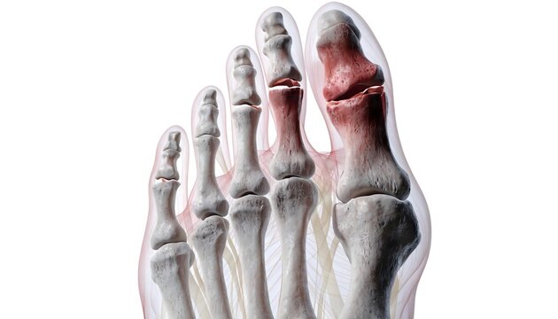 Detailed 3D medical illustration of a human foot featuring a fracture in the phalanges and metatarsals. Translucent soft tissues and a red highlighted break on a white background for clinical use.