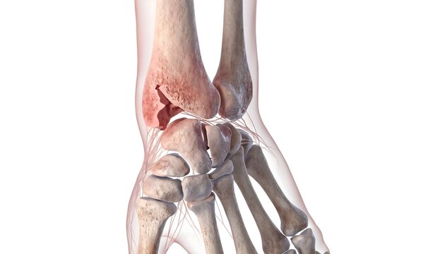 Detailed 3D medical illustration of a fractured human wrist featuring a broken distal radius and scaphoid. Translucent soft tissues and a highlighted red break on a white background for clinical use.