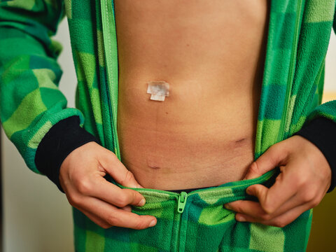 Boy's torso revealing their midsection and a small bandage on their abdomen after surgery