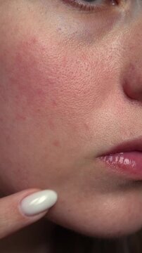 Close up of woman pointing at acne and skin imperfection on cheek. Concept of facial skincare problems, dermatology, acne treatment and natural skin condition.