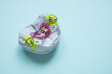An orthodontic plate with an orthodontic screw for widening a child's upper jaw. Correcting dental alignment in children is a medical concept. © dore art