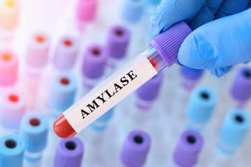 Obraz premium Doctor holding amylase blood test tube explaining pancreatic enzyme levels for digestive function assessment, acute pancreatitis detection and clinical laboratory diagnostics